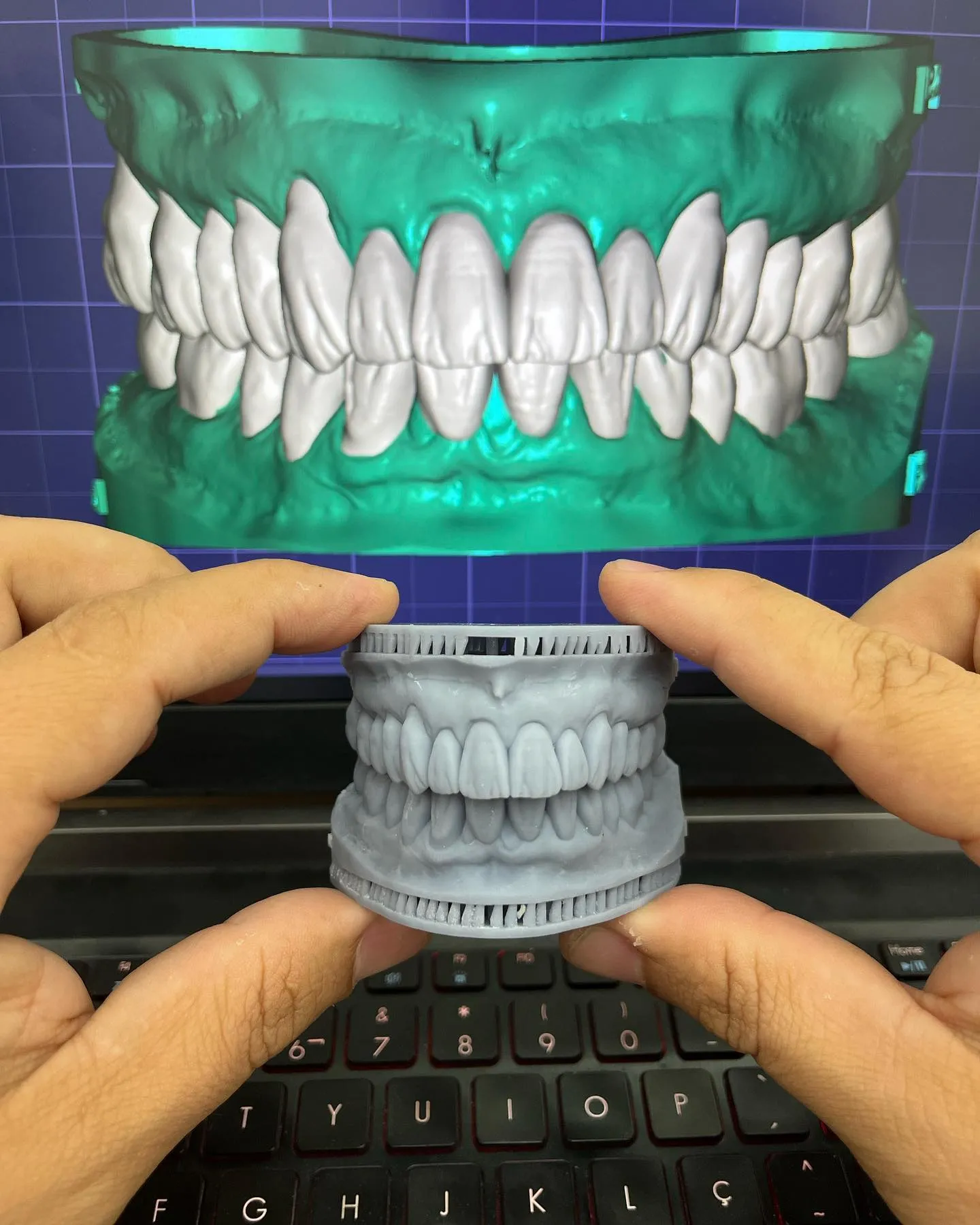 Planejamento digital CAD/CAM ao lado da prótese impressa