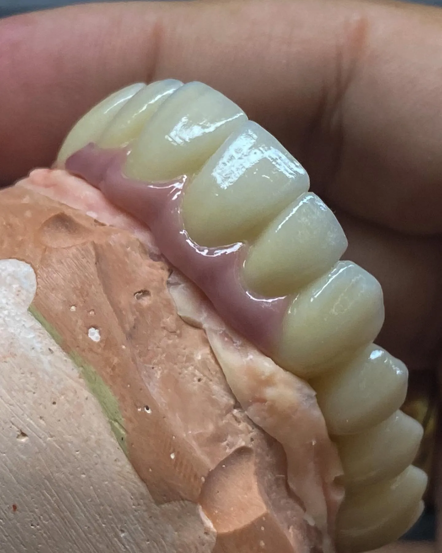 Prótese fixa em modelo